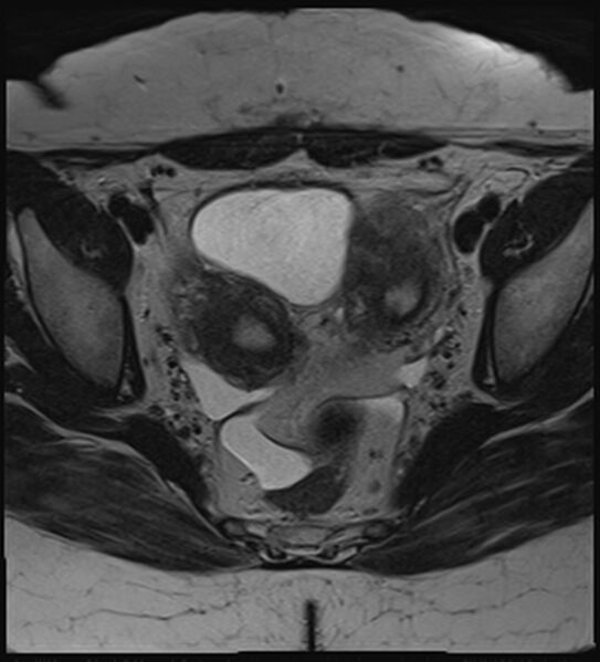 File:Bicornuate, unicollis uterus (Radiopaedia 79468-92593 Axial T2 11).jpg