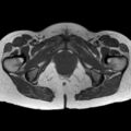 Bicornuate uterus (Radiopaedia 61974-70046 Axial T1 40).jpg