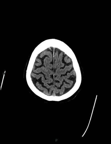 File:Bilateral acute middle cerebral artery territory infarcts (Radiopaedia 77319-89401 Axial non-contrast 78).jpg
