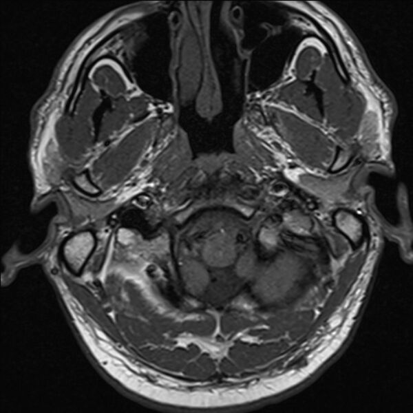 File:Bilateral cholesteatoma (Radiopaedia 54898-61173 Axial T1 1).jpg