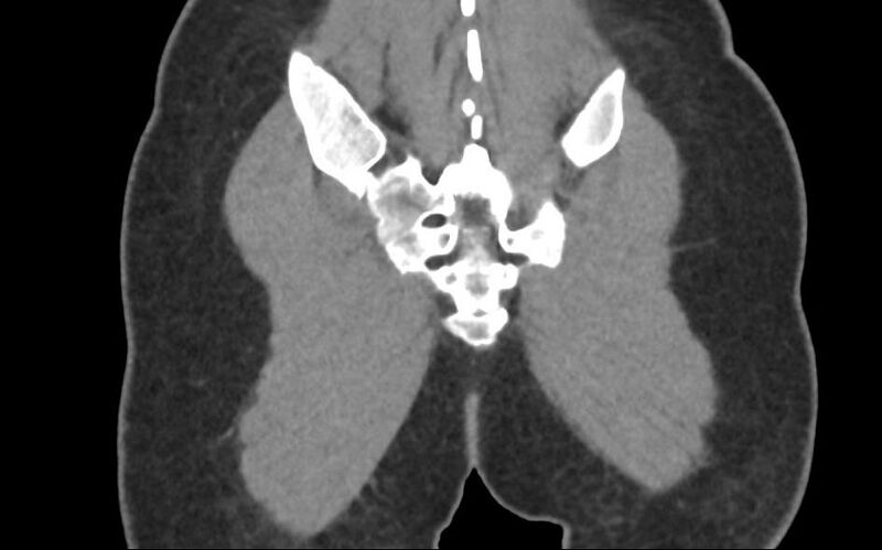File:Bilateral mature cystic ovarian teratoma (Radiopaedia 88821-105592 Coronal non-contrast 46).jpg