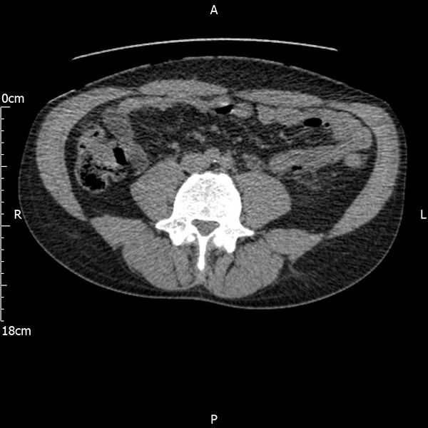 File:Bilateral medullary nephrocalcinosis with ureteric calculi (Radiopaedia 71269-81569 Axial non-contrast 74).jpg