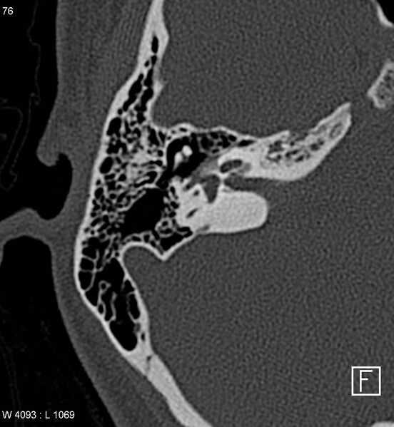 File:Bilateral otosclerosis with left stapes prosthesis (Radiopaedia 5567-7302 Axial bone window 9).jpg