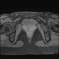 Bilateral ovarian endometriomas (Radiopaedia 87085-103347 Axial T1 fat sat 19).jpg