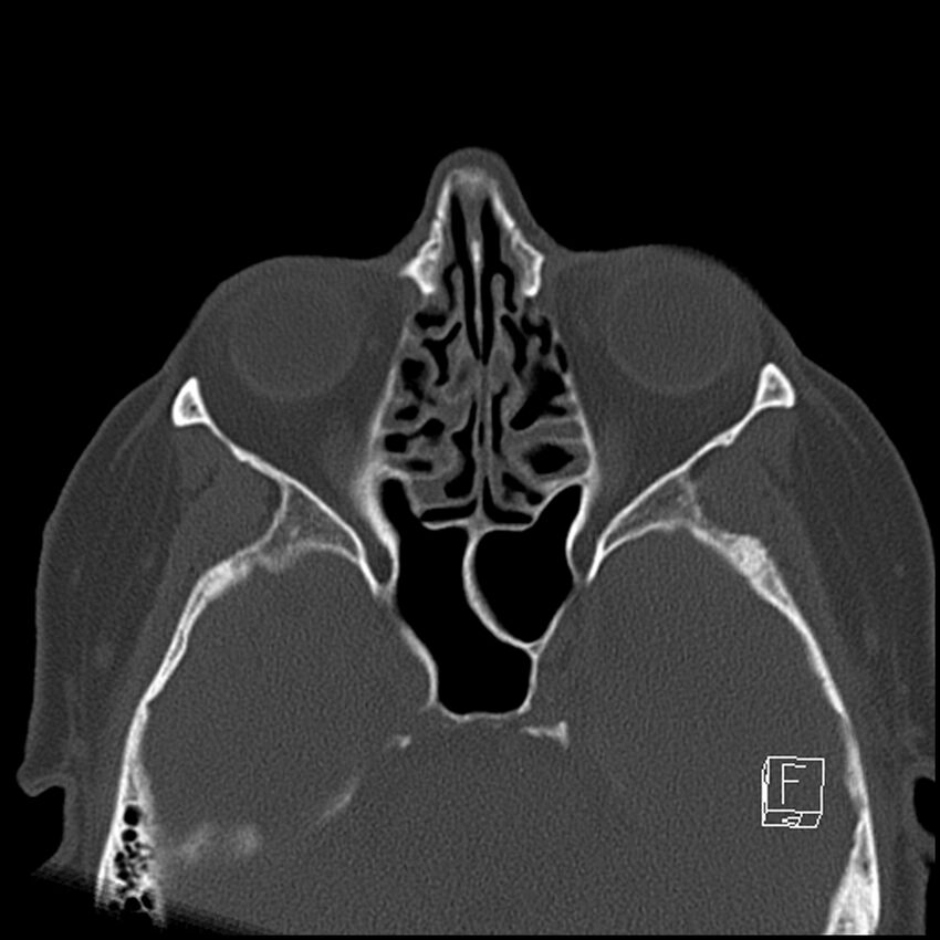 Bilateral palatine tonsilloliths on OPG and CT (Radiopaedia 75167-86247 Axial bone window 11).jpg