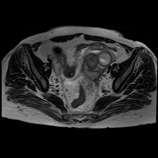 File:Bilateral tubo-ovarian abscesses (Radiopaedia 58635-65829 Axial T2 20).jpg