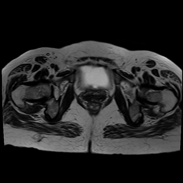 File:Bilateral tubo-ovarian abscesses (Radiopaedia 58635-65829 Axial T2 39).jpg
