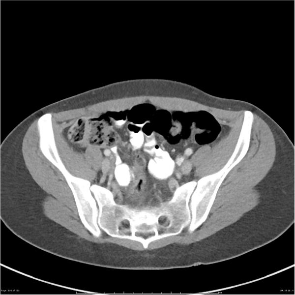 File:Bilateral ureteritis and cystitis (Radiopaedia 25340-25594 A 59).jpg