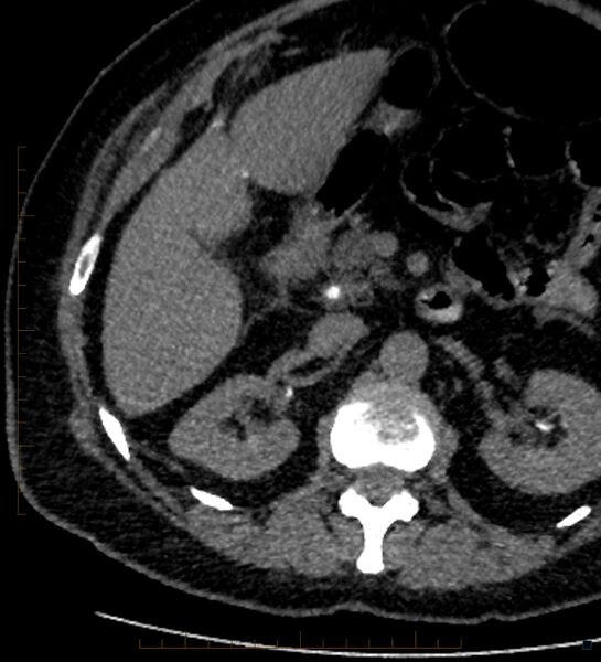 File:Bile leak from accessory duct(s) of Luschka post cholecystectomy (Radiopaedia 40736-43389 A 40).jpg