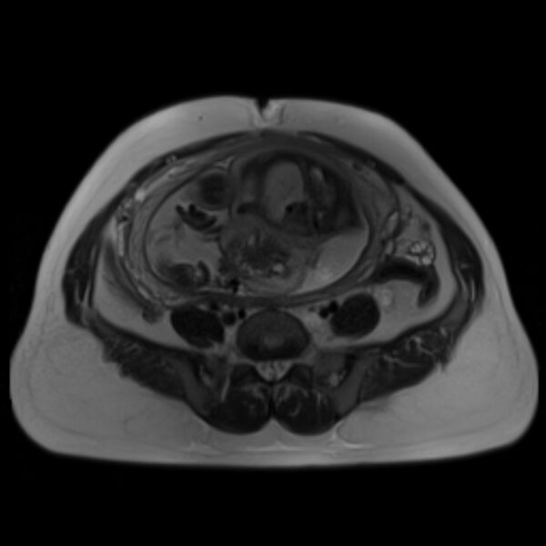 File:Bilobed placenta accreta (Radiopaedia 69648-79591 Axial T2 27).jpg
