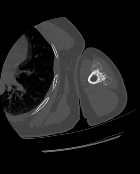 File:Bizarre parosteal osteochondromatous proliferation (Radiopaedia 84221-99501 Axial bone window 86).jpg