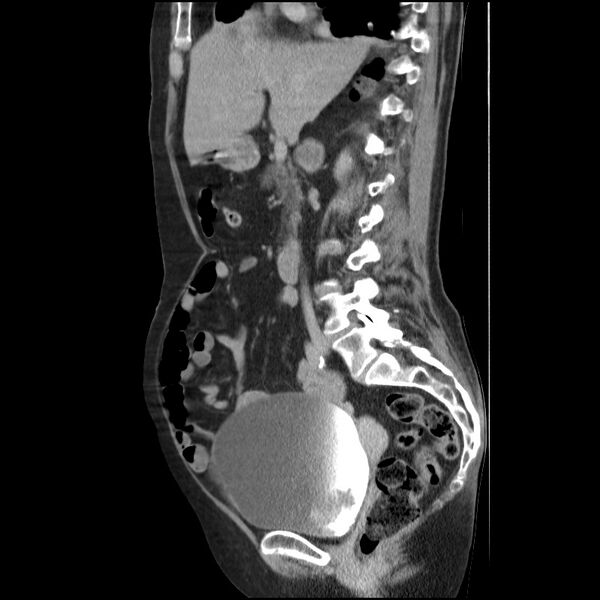 File:Bladder tumor detected on trauma CT (Radiopaedia 51809-57609 E 42).jpg