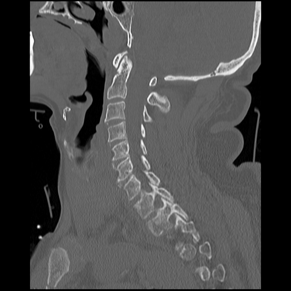 File:Blunt cerebrovascular injury (Radiopaedia 53682-59743 Sagittal bone window 9).png
