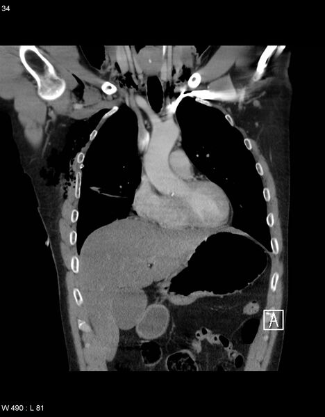 File:Boerhaave syndrome with tension pneumothorax (Radiopaedia 56794-63605 B 12).jpg