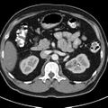 Bosniak cyst - type IV (Radiopaedia 23525-23627 renal cortical phase 16).jpg
