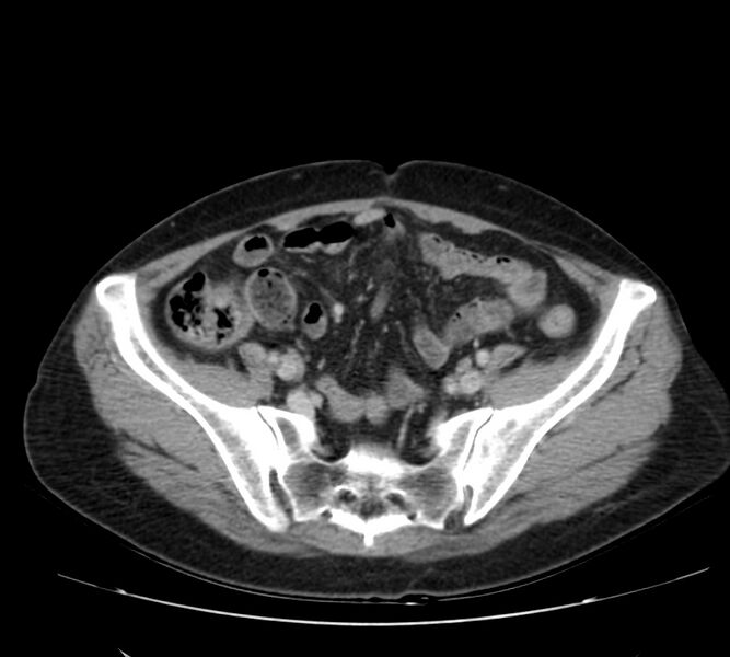 File:Bosniak renal cyst - type IV (Radiopaedia 22929-22953 C 51).jpg