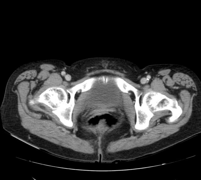File:Bosniak renal cyst - type IV (Radiopaedia 22929-22953 C 67).jpg