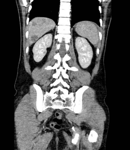 File:Bowel obstruction from colon carcinoma (Radiopaedia 22995-23028 C 58).jpg