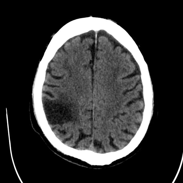 File:Brain Pantopaque remnants (Radiopaedia 78403-91048 Axial non-contrast 65).jpg