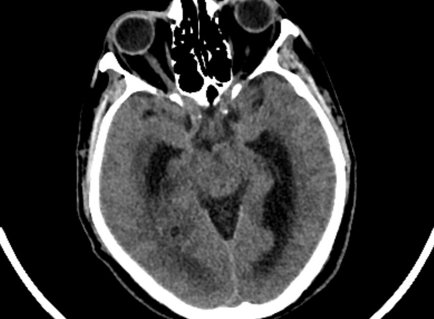 Brain abscess complicated by intraventricular rupture and ventriculitis (Radiopaedia 82434-96575 Axial non-contrast 21).jpg