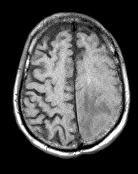 File:Brain abscess with dual rim sign (Radiopaedia 87566-103938 Axial T1 19).jpg