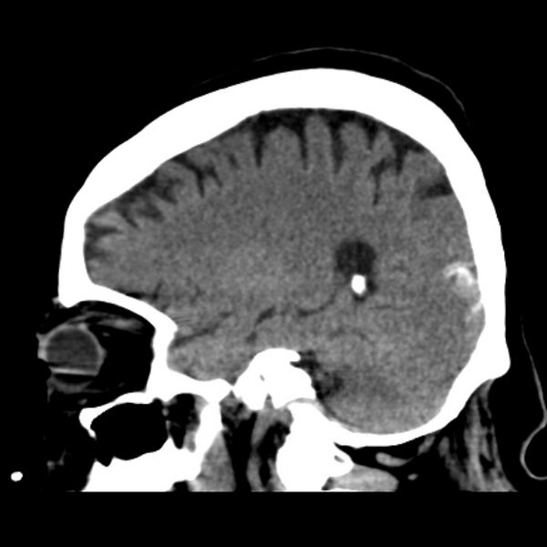 File:Brain cortical laminar necrosis (Radiopaedia 25822-25971 non-contrast 18).jpg