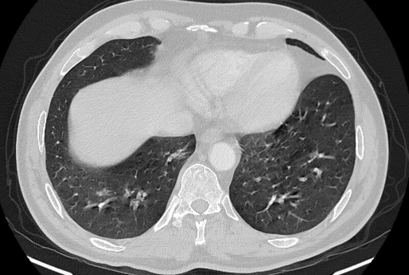 File:Brain metastases - lung cancer primary (Radiopaedia 75060-86116 Axial lung window 47).jpg