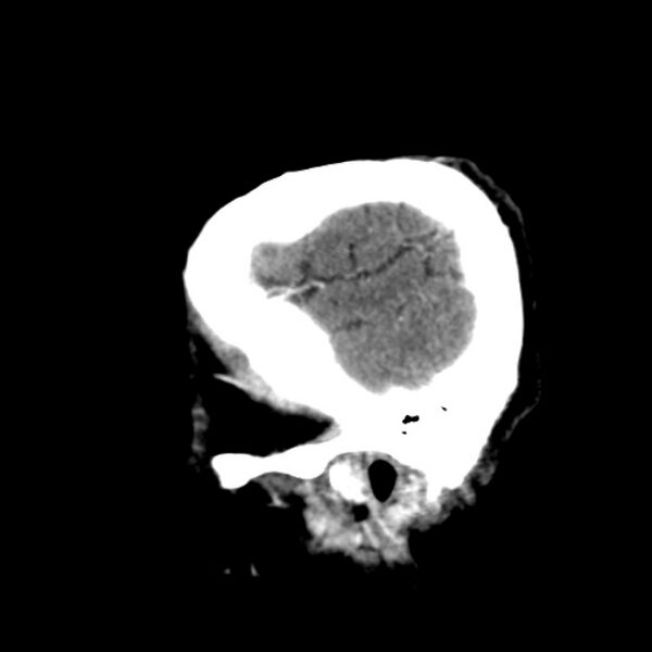 File:Brain metastases from lung cancer (Radiopaedia 24480-24781 C+ delayed 52).jpg