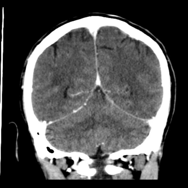 File:Brain metastases from lung cancer (Radiopaedia 24480-24781 Coronal C+ delayed 46).jpg