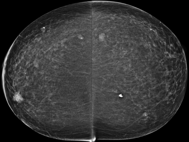 File:Breast cancer and multiple circumscribed masses (Radiopaedia 62456-70698 CC 1).jpeg