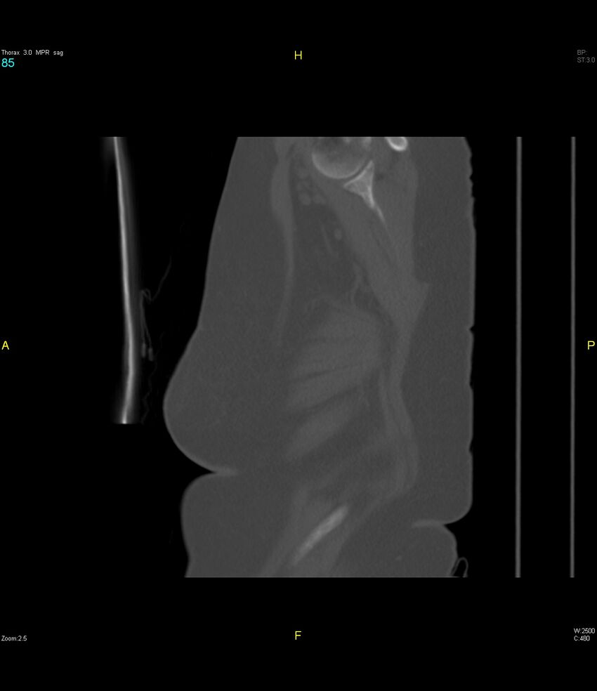 Breast primary with lung and bone metastases (Radiopaedia 40620-43228 Sagittal bone window 85).jpg