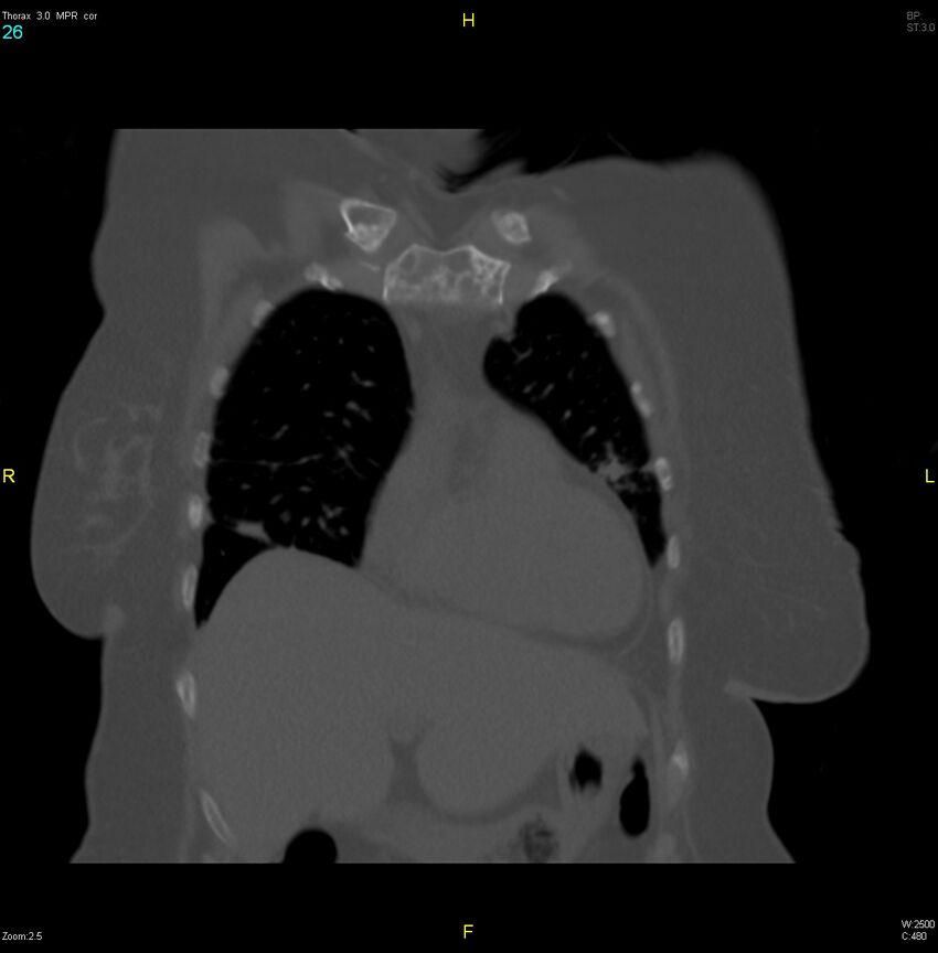 Breast primary with lung and bone metastases (Radiopaedia 40620-43228 bone window 26).jpg