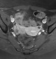 Broad ligament leiomyoma (Radiopaedia 81634-95516 Axial T1 C+ fat sat 11).jpg