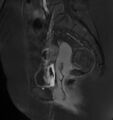 Broad ligament leiomyoma (Radiopaedia 81634-95516 G 16).jpg