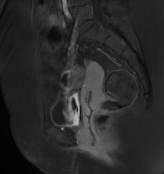 File:Broad ligament leiomyoma (Radiopaedia 81634-95516 G 16).jpg