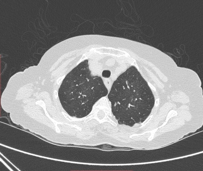 Bronchiectasis (Radiopaedia 72693-83293 Axial lung window 19).jpg
