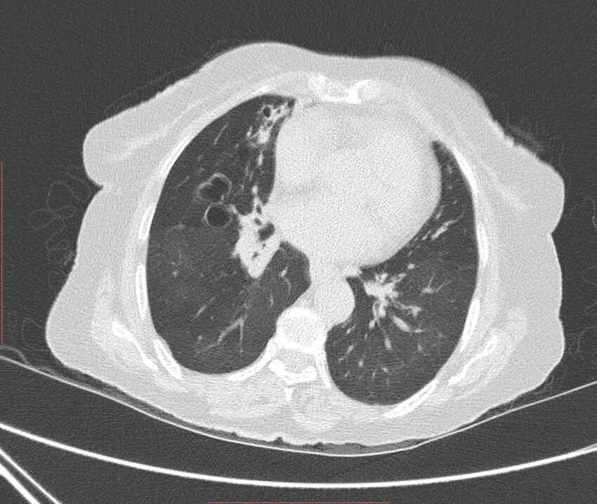 Bronchiectasis (Radiopaedia 72693-83293 Axial lung window 79).jpg