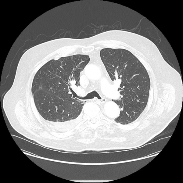 File:Bronchogenic adenocarcinoma and pulmonary embolism (Radiopaedia 9097-9806 Axial lung window 12).jpg