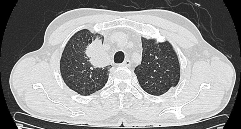 File:Bronchogenic carcinoma with superior vena cava syndrome (Radiopaedia 36497-38054 Axial lung window 24).jpg