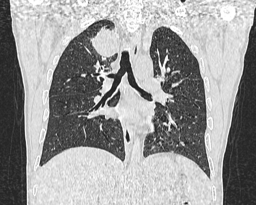Bronchogenic carcinoma with superior vena cava syndrome (Radiopaedia 36497-38054 Coronal lung window 51).jpg