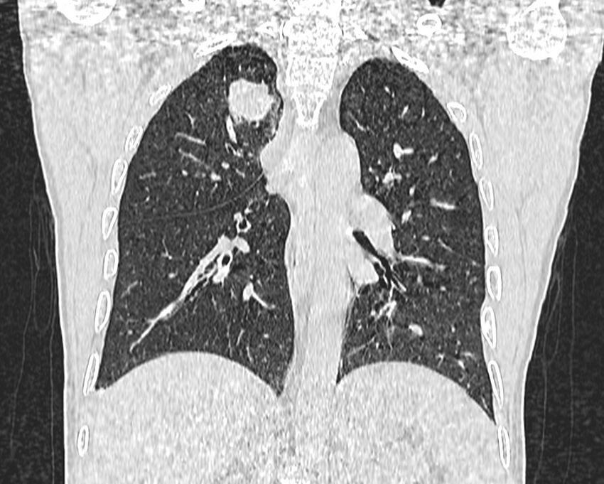 Bronchogenic carcinoma with superior vena cava syndrome (Radiopaedia 36497-38054 Coronal lung window 60).jpg