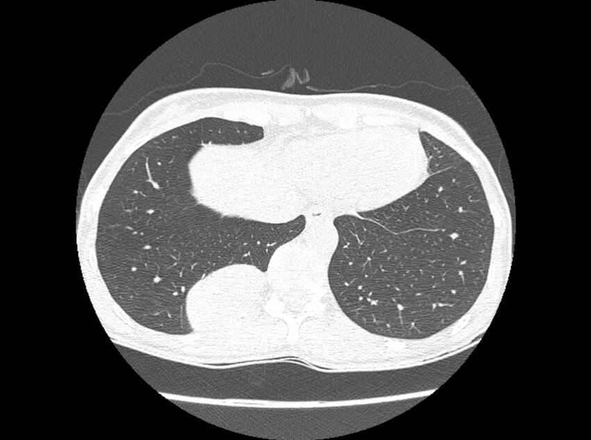 Bronchogenic cyst (Radiopaedia 80273-93615 Axial lung window 19).jpg