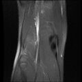 Bucket handle tear - lateral meniscus (Radiopaedia 72124-82634 Coronal PD fat sat 15).jpg