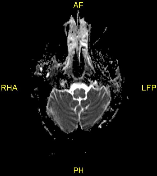 File:Butterfly glioma (Radiopaedia 76707-88526 Axial ADC 4).jpg