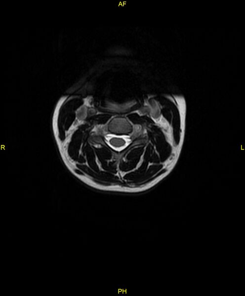 File:C5 nerve sheath tumor (Radiopaedia 85777-101596 Axial T2 19).jpg