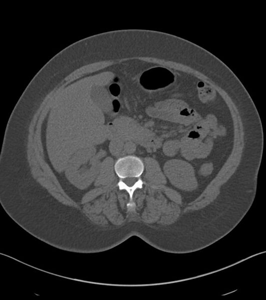 File:Calcified hepatic hydatid cyst (Radiopaedia 81127-94738 Axial non-contrast 44).jpg