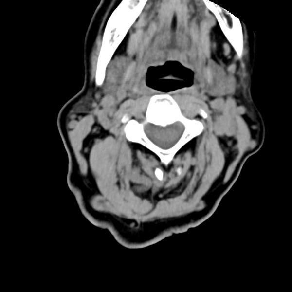 File:Calcified meningioma - cervical canal (Radiopaedia 70136-80171 B 14).jpg