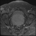 Cancer cervix - stage IIb (Radiopaedia 75411-86615 T1 fat sat 16).jpg