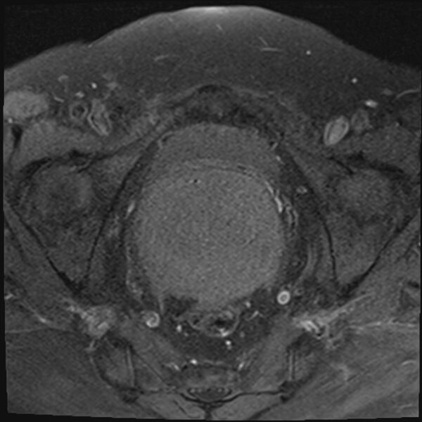 File:Cancer cervix - stage IIb (Radiopaedia 75411-86615 T1 fat sat 16).jpg