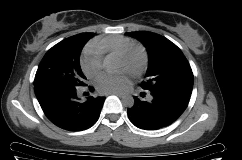 File:Cannonball metastases - uterine choriocarcinoma (Radiopaedia 70137-80173 Axial non-contrast 60).jpg